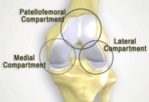 va disability compensation knee replacment